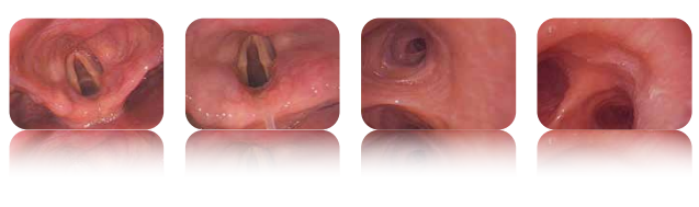 可视喉镜 可视喉镜