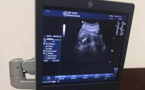 阴道B超 阴道B超