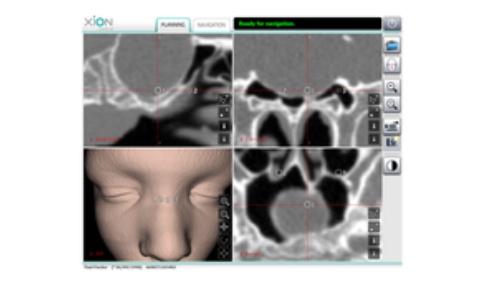 内窥镜投射技术 内窥镜投射技术